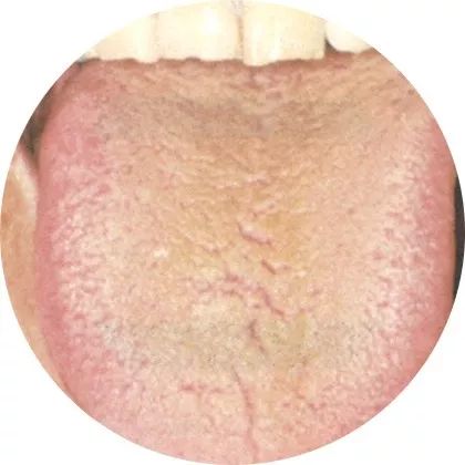 燥苔：吐泻伤津