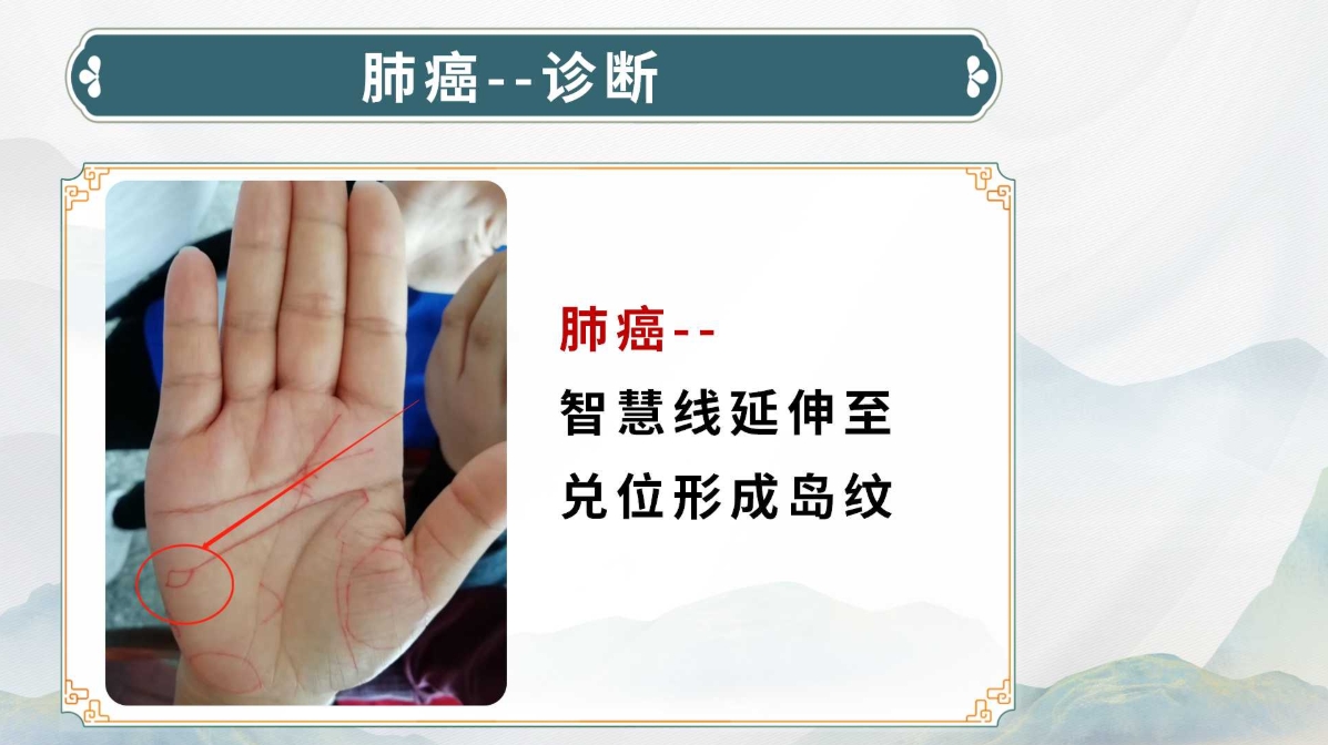 生命全息手诊——肺癌诊断方法(附调理方案)! 生命全息手诊——肺癌诊断方法(附调理方案)!