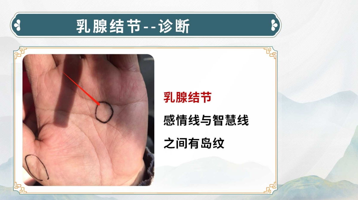 生命全息手诊——乳腺结节诊断方法(附调理方案)! 生命全息手诊——乳腺结节诊断方法(附调理方案)!