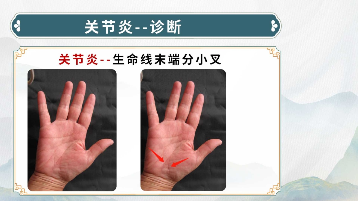 生命全息手诊——关节炎诊断方法(附调理方案)! 生命全息手诊——关节炎诊断方法(附调理方案)!