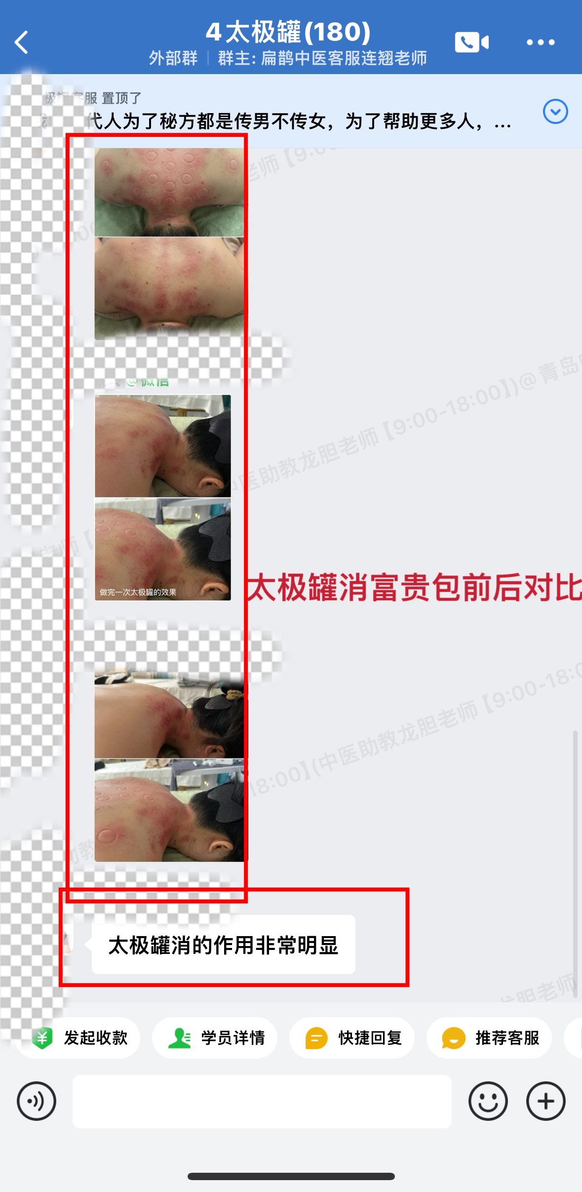 陈实功太极罐学员反馈:美容针扎好了眼睛问题和舌尖麻问题,太极罐消富贵包非常明显! 陈实功太极罐学员反馈:美容针扎好了眼睛问题和舌尖麻问题,太极罐消富贵包非常明显!